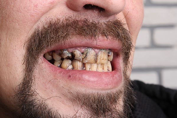 enfermedades-dentales-comunes-cáncer oral