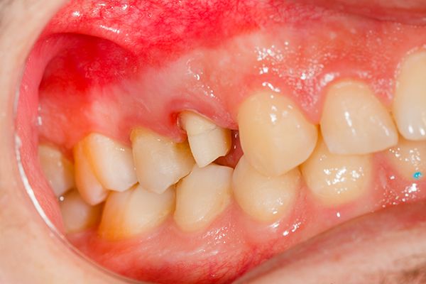 enfermedades-dentales-comunes-gingivitis