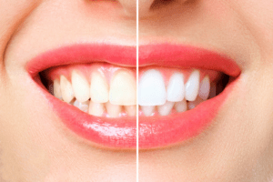 Blanqueamiento dental